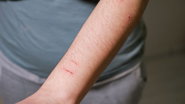 what is cat scratch disease in Charlotte, NC